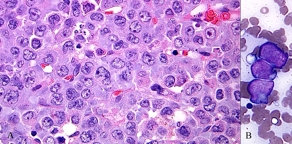 Bone marrow core biopsy and touch preparation. (A) The biopsy shows sheets of large irregular blasts with folded nuclei and a monocytic appearance. (B) Representative blasts from touch preparation.